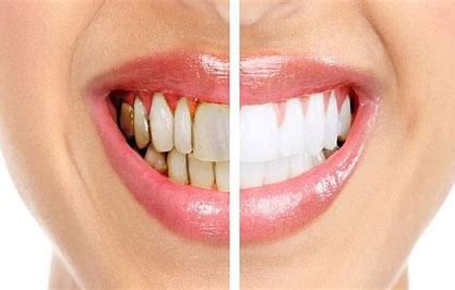 ๐ Draft Ebook Title: Understanding Tooth Decay: Causes, Prevention, and Treatment Author: Youssef Farhat