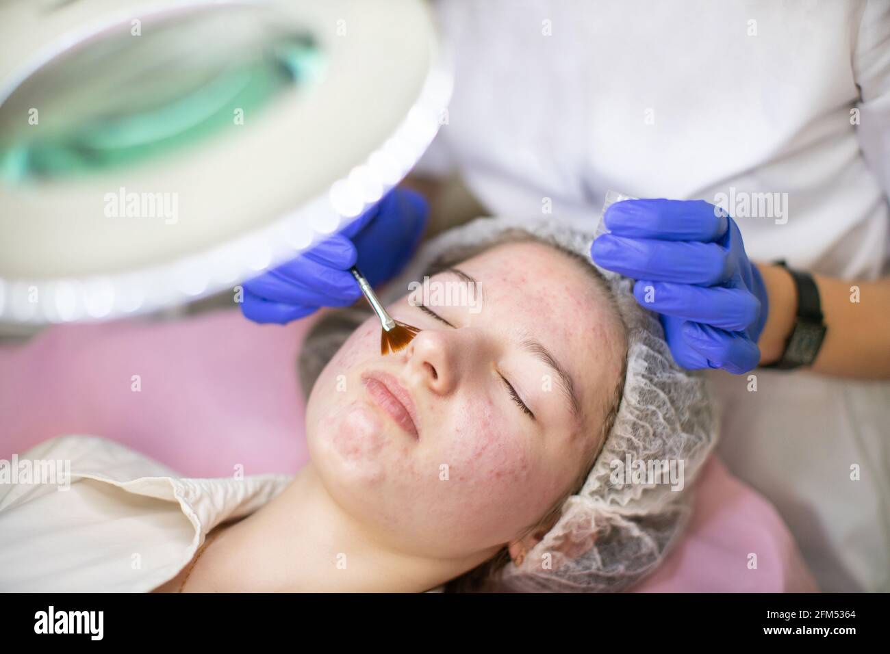 The Problem of Acne – A Concise Professional Guide