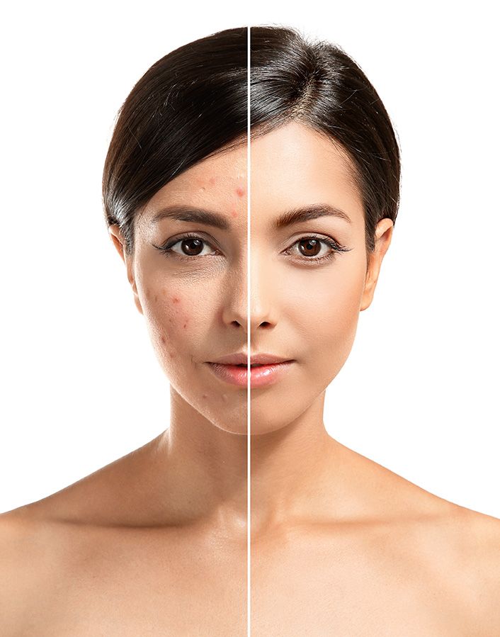 The Problem of Acne – A Concise Professional Guide