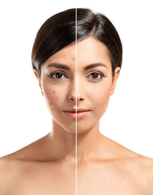 The Problem of Acne – A Concise Professional Guide